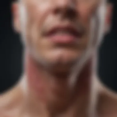 Clinical Presentation of Median Rhomboid Glossitis Clinical presentation of median rhomboid glossitis