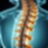 Diagram of spinal cord affected by myelomalacia