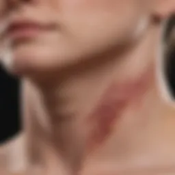 An illustration depicting the distinct lesions associated with Acne Keloidalis Nuchae at the nape of the neck.